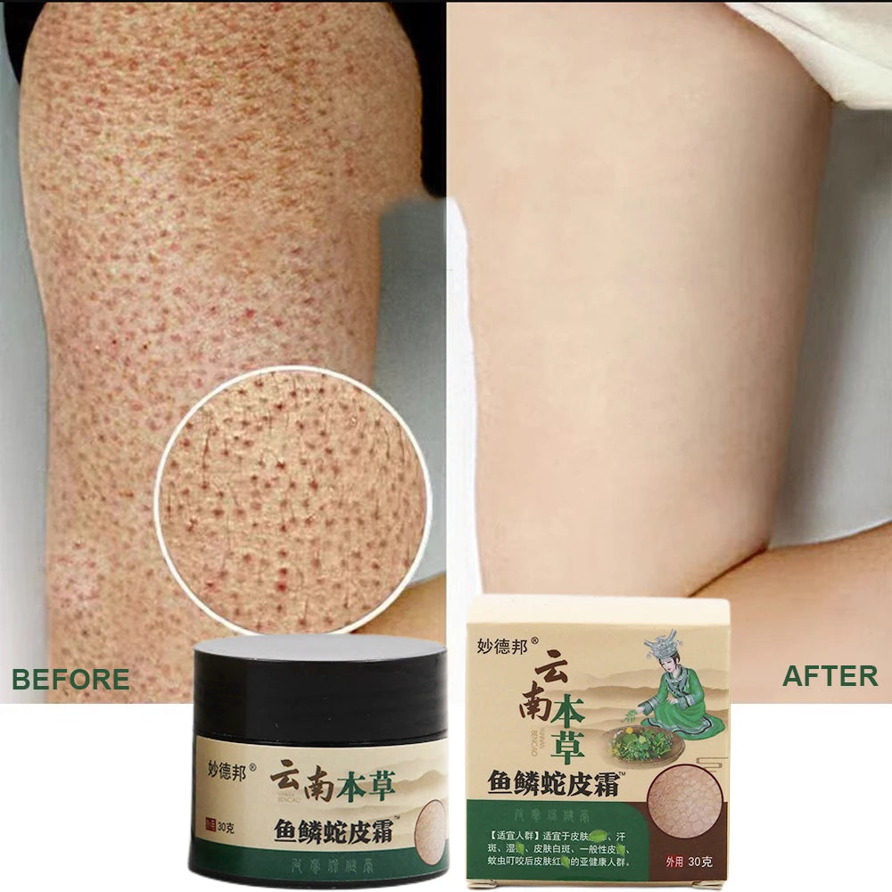 Herbal Repair Chicken Skin Cream Moisturize Remove Thick Pore Dark Spot Body Scrub Curing Keratosis Follicle Pilaris Smooth Skin